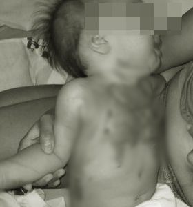 10 month-old nga bata sa Oton nalapnos ang lawas sang naulaan sang mainit nga sabaw